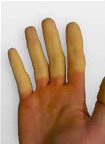 Raynaud's (Medium).jpg